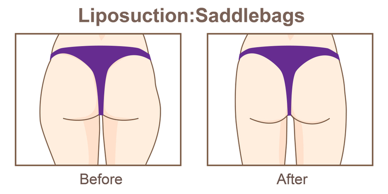 How Do You Get Rid Of Cellulite And Saddlebags? How Do You Get Rid Of Cellulite And Saddlebags?